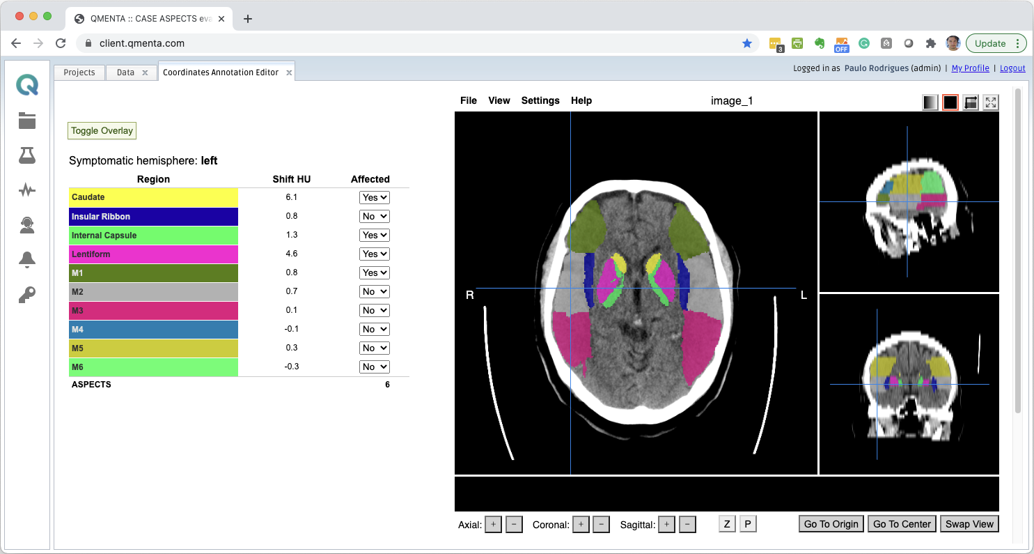 Screenshot of QMENTA platform showing a brain segmentation. Screenshot of QMENTA platform showing a brain segmentation.